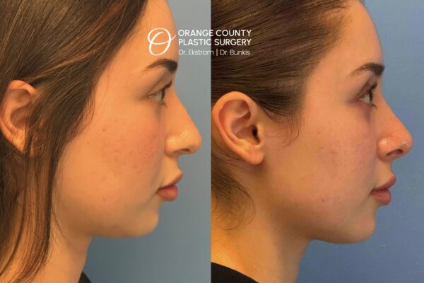 Rhinoplasty, 22-year-old 1