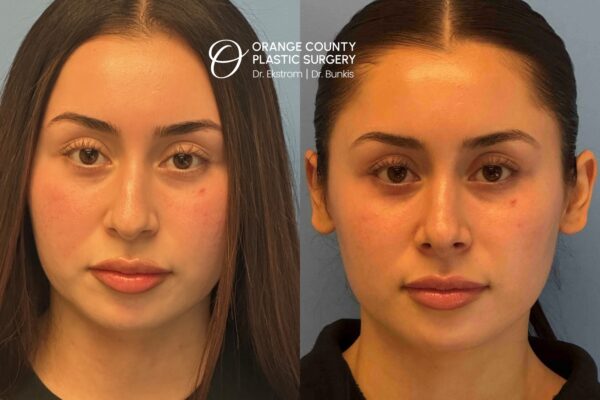 Rhinoplasty, 22-year-old 2